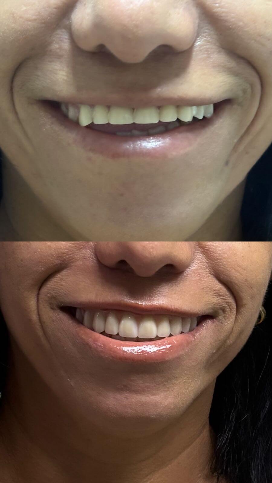 Antes e depois de reabilitação oral
